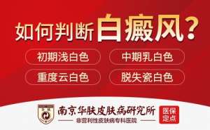 白癜风会传染给别人吗“南京华肤皮肤病研究所作息时间表”